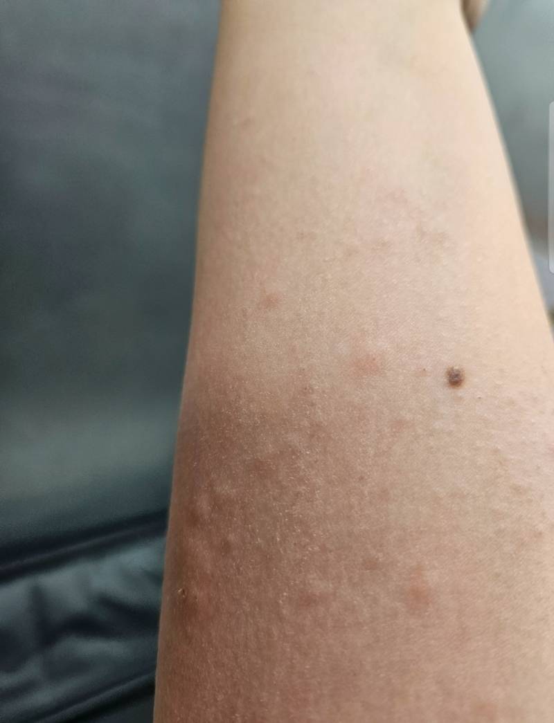 [잡담] 팔에 이런식으로 빨간점이 생겼는데 뭘까??? (혐) | 인스티즈