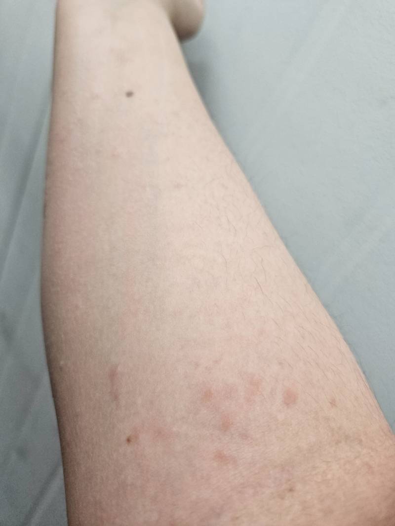 [잡담] 팔에 이런식으로 빨간점이 생겼는데 뭘까??? (혐) | 인스티즈