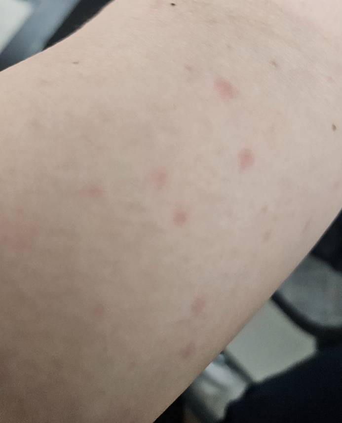 [잡담] 팔에 이런식으로 빨간점이 생겼는데 뭘까??? (혐) | 인스티즈