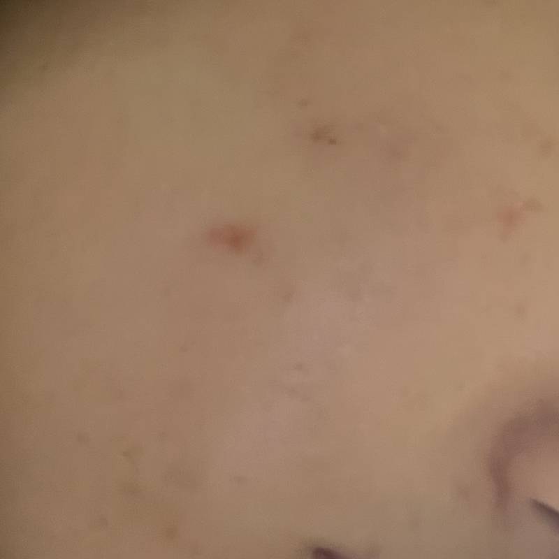 [잡담] 사진 ㅎㅇㅈㅇ) 이거 모낭염인가?ㅜㅜ | 인스티즈