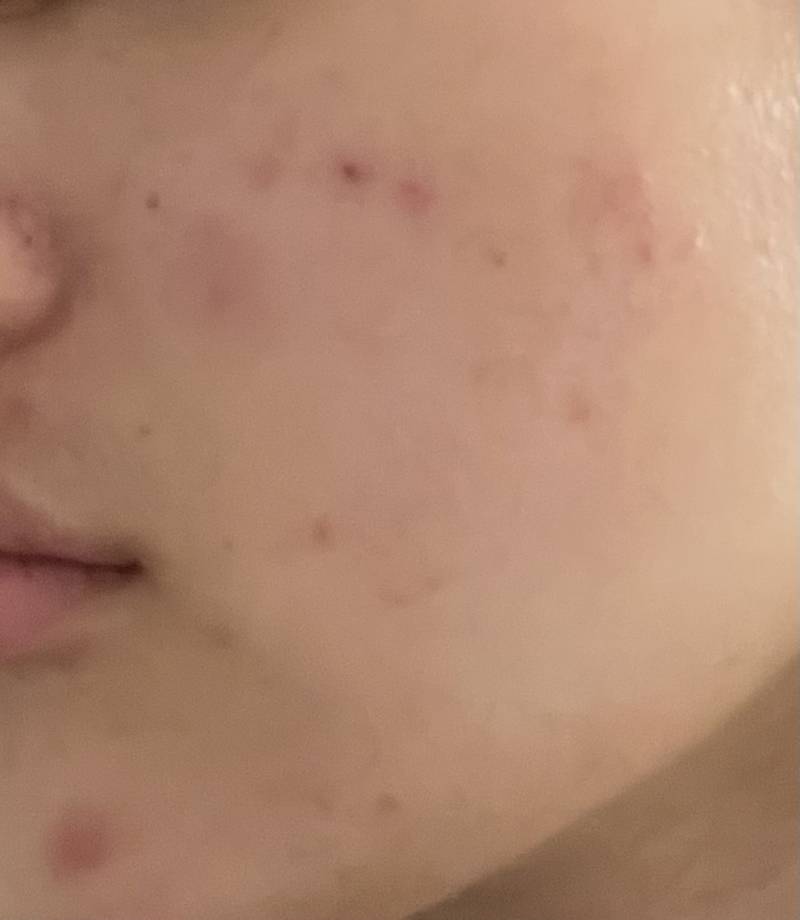 [잡담] 사진 ㅎㅇㅈㅇ) 이거 모낭염인가?ㅜㅜ | 인스티즈