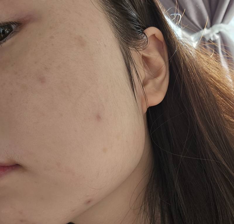 [잡담] 얘들아ㅜㅜㅜ나좀 도와줘 나 갑자기 얼굴에 이런 뾰루지가 너무많이나... | 인스티즈