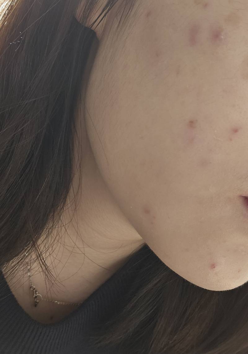 [잡담] 얘들아ㅜㅜㅜ나좀 도와줘 나 갑자기 얼굴에 이런 뾰루지가 너무많이나... | 인스티즈