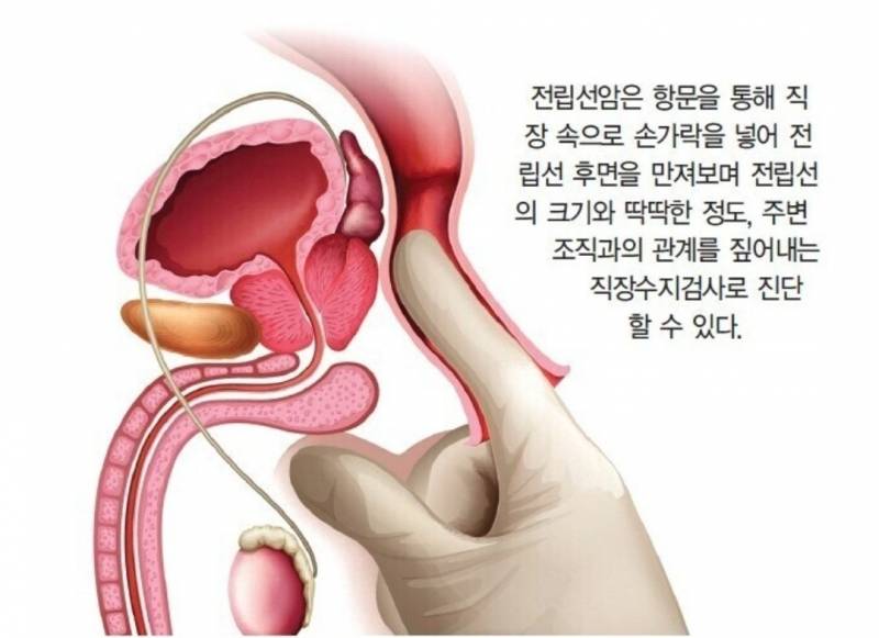[잡담] 전립선은 원래 딱딱해? | 인스티즈