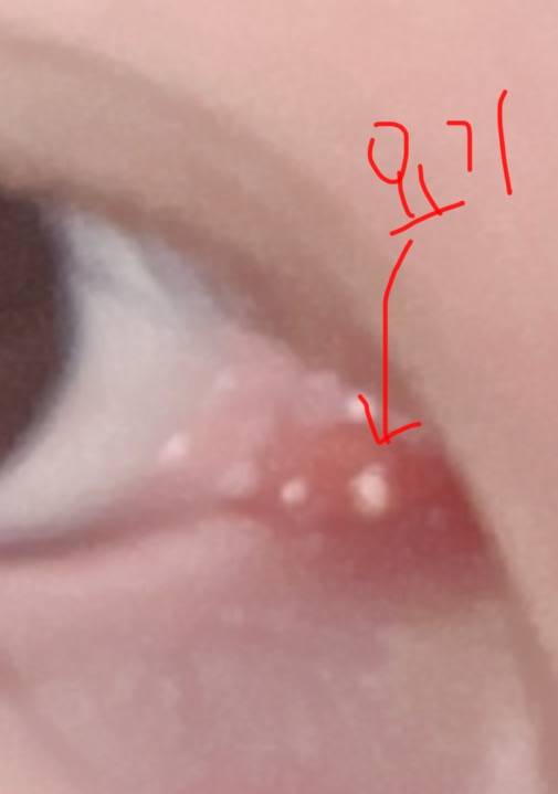 [잡담] 눈 앞머리에 뭐 났는데ㅠㅠ 이게 뭐야 | 인스티즈