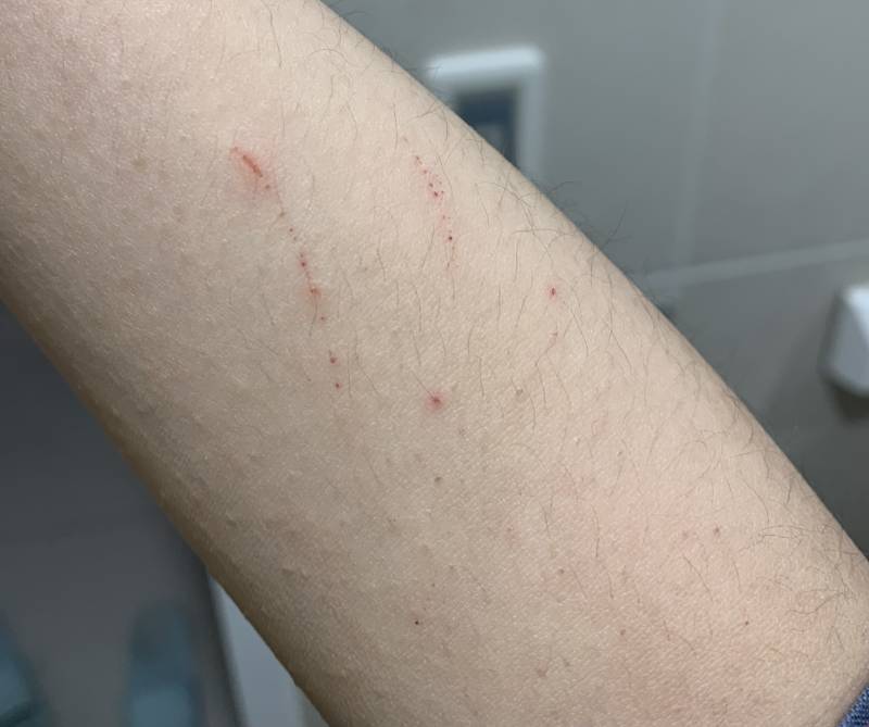 [잡담] 이 정도 상처면 마데카솔이랑 대일밴드 바를거야? | 인스티즈