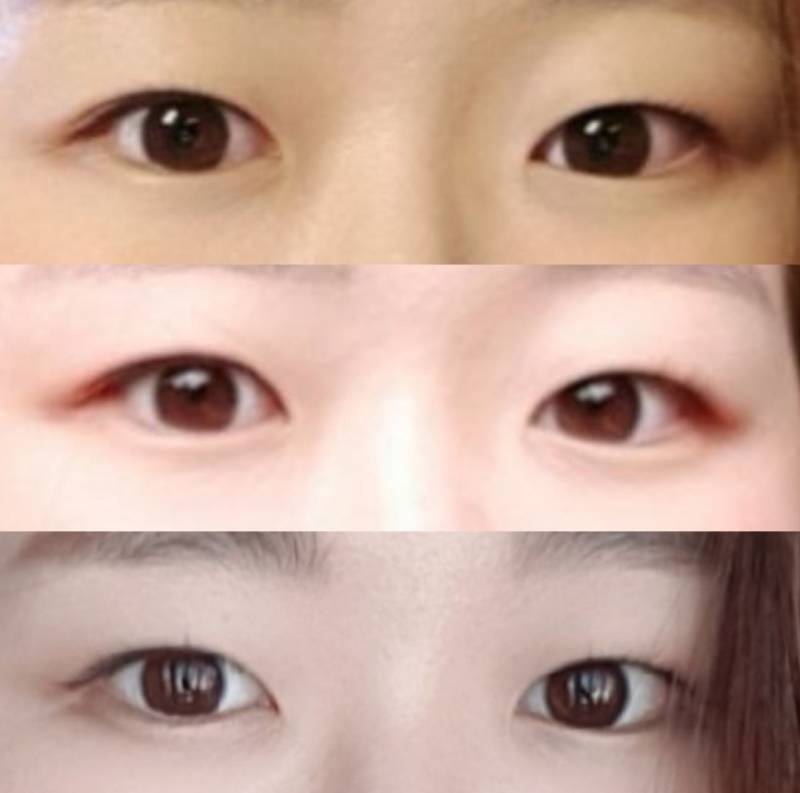 [잡담] 난 쌍수 하는게 낫겠지?.. | 인스티즈