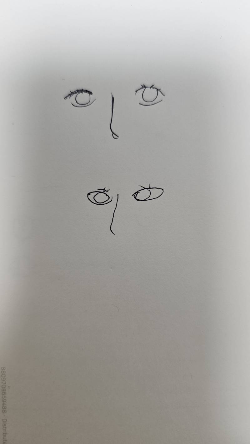 [잡담] 코수술 5일차인데 입도 이제 어느정도 움직일 정도로 붓기풀렸는데 눈이 ㅜ ㅜ | 인스티즈