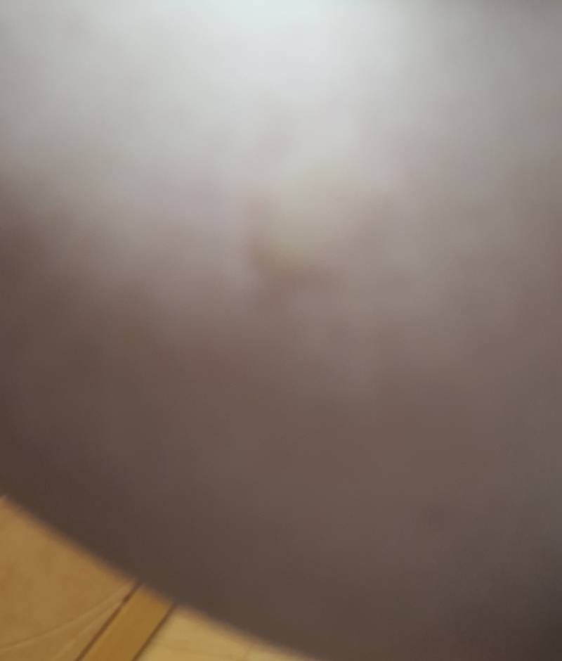 [잡담] 종아리에 이런거 나는 사람? | 인스티즈