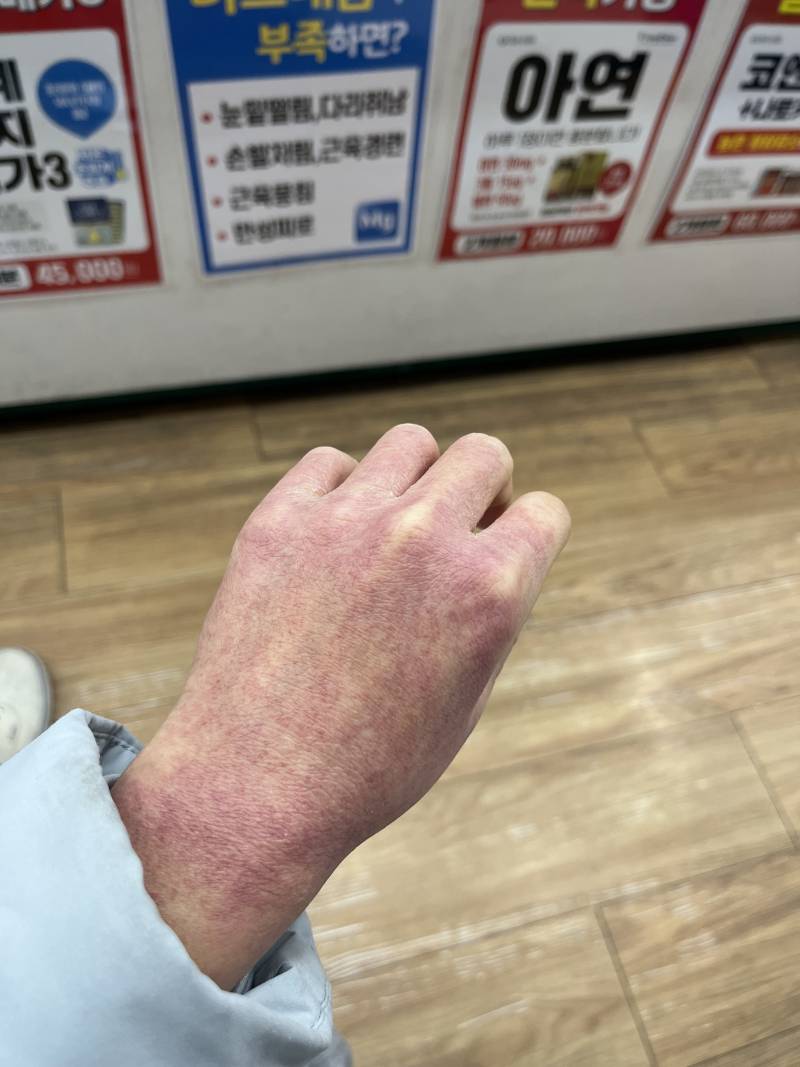 [잡담] 나 손피부 개심각했던 사진 볼 사람 (혐오주의) | 인스티즈