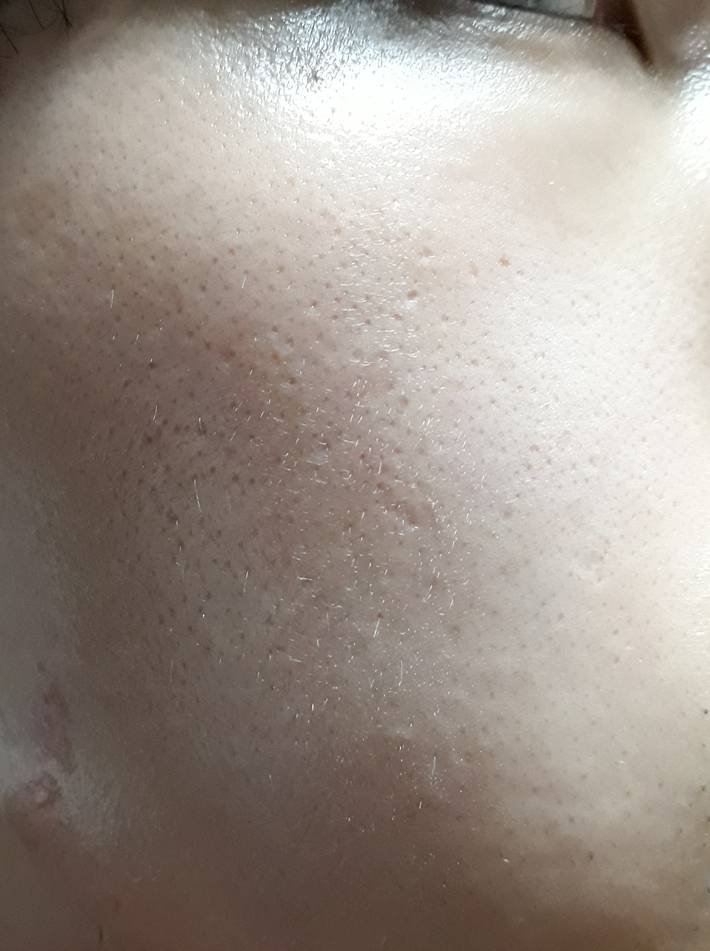 [잡담] 나 모공성 흉터가 많이 좋아졌거든?? | 인스티즈