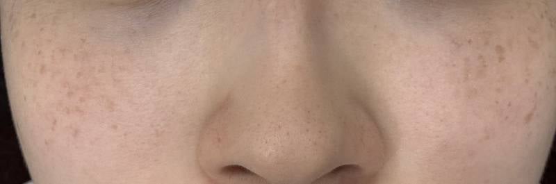 [잡담] 와 나 주근깨 진짜 많이 없어졌다!! | 인스티즈