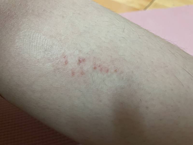 [잡담] 종아리 안마기 쓰다가 상처남 (다리털주의) | 인스티즈