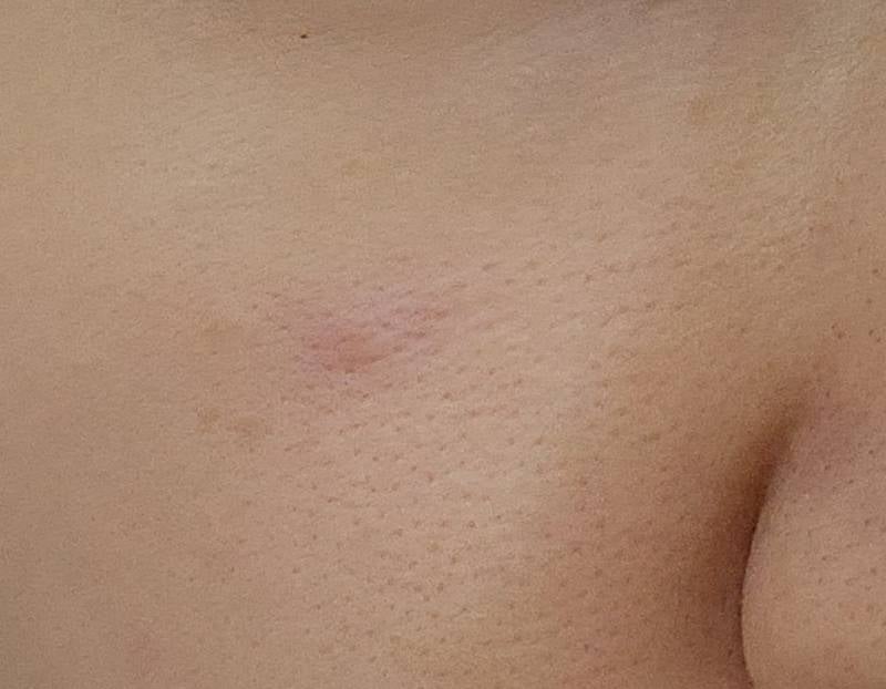 [잡담] 얼굴에 뾰루지가 났는데 한달째 안없어지는데 사진좀ㅈ봐줄수잇어? 한번만도와줘 얼굴사진잇어 | 인스티즈