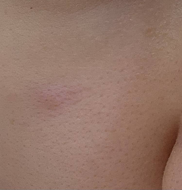 [잡담] 얼굴에 뾰루지가 났는데 한달째 안없어지는데 사진좀ㅈ봐줄수잇어? 한번만도와줘 얼굴사진잇어 | 인스티즈
