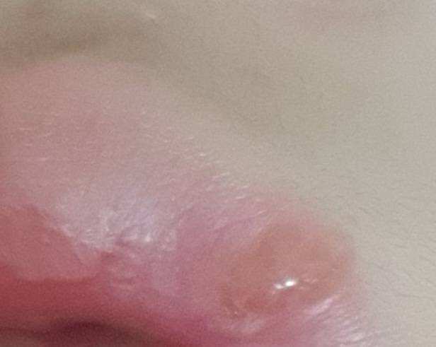 [잡담] 윗입술 수포? 났는데 | 인스티즈