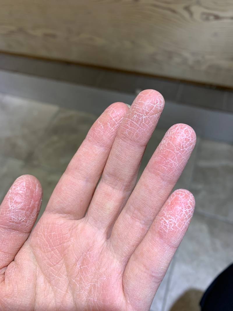 [잡담] 나 한때 손 텄던 거 봐.. | 인스티즈