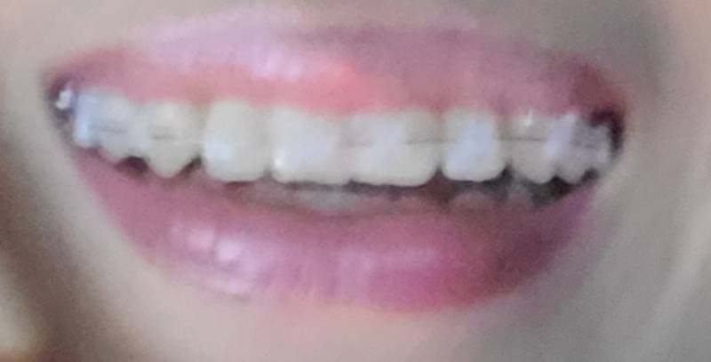 [잡담] 교정익들아 교정 전 후 어때 | 인스티즈