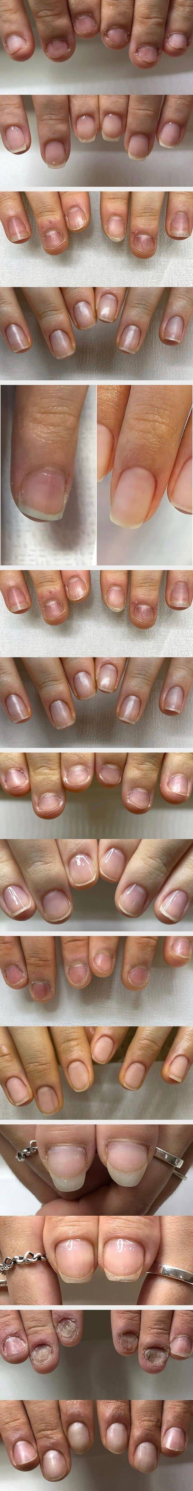 현재 반응터진 손톱 교정술...JPG | 인스티즈