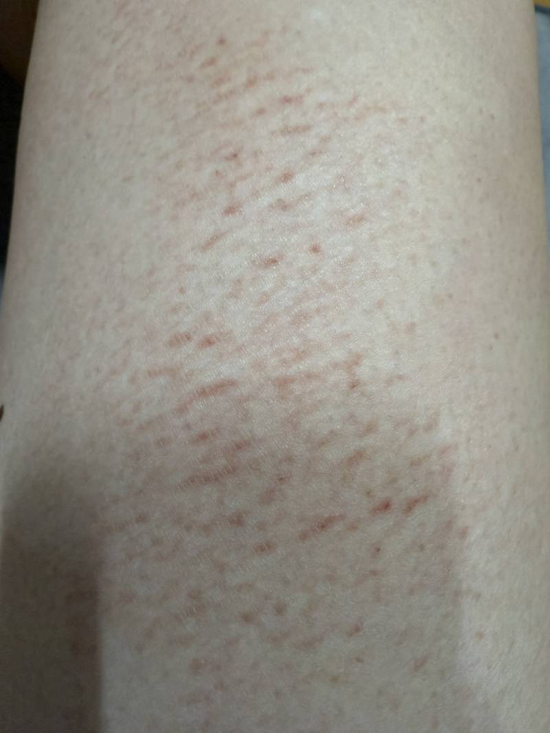 [잡담] 다들 바디로션이나 보습크림 꼭 발라 (혐오주의) | 인스티즈