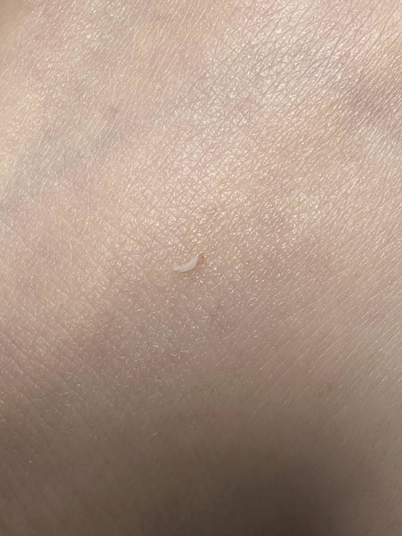[잡담] 비립종 짰어... (ㅎㅇㅈㅇ) | 인스티즈