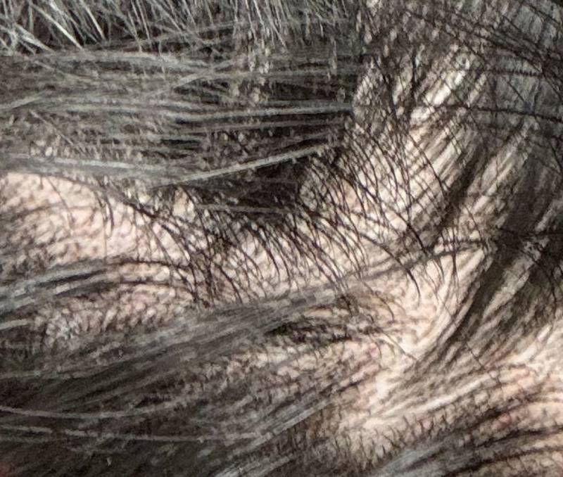 [잡담] 옆머리 이런거 탈모 맞지 않아? 언니가 병원을 안 가 | 인스티즈