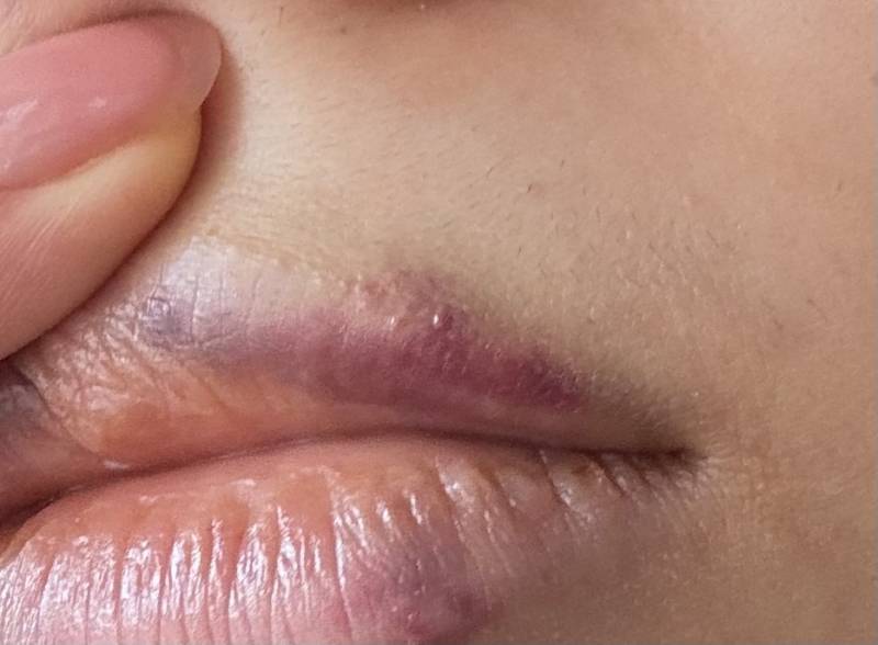 [잡담] 입술필러 맞았는데 부작용인가?ㅠㅠㅠ | 인스티즈