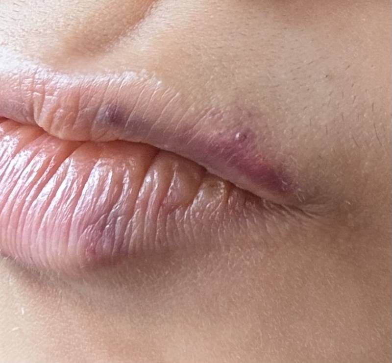 [잡담] 입술필러 맞았는데 부작용인가?ㅠㅠㅠ | 인스티즈