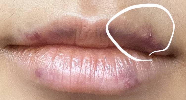 [잡담] 입술필러 맞았는데 부작용인가?ㅠㅠㅠ | 인스티즈