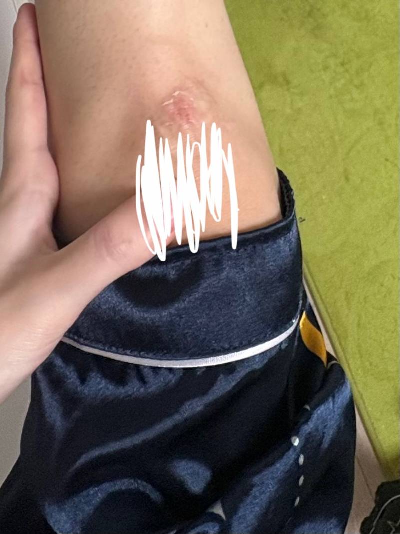 [잡담] ㅎㅇㅈㅇ 나 강아지 산책하다가 넘어져서 무릎까졌어ㅠㅠ | 인스티즈