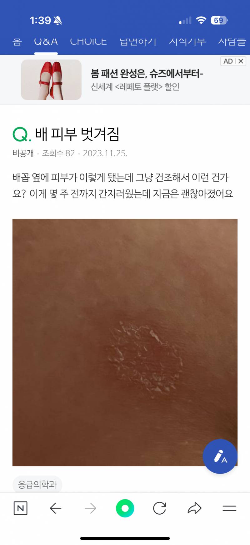 [잡담] 배꼽 밑에 피부가 살짝 벗겨지듯이 갈라졌는데 건조해서 그런걸까?? | 인스티즈