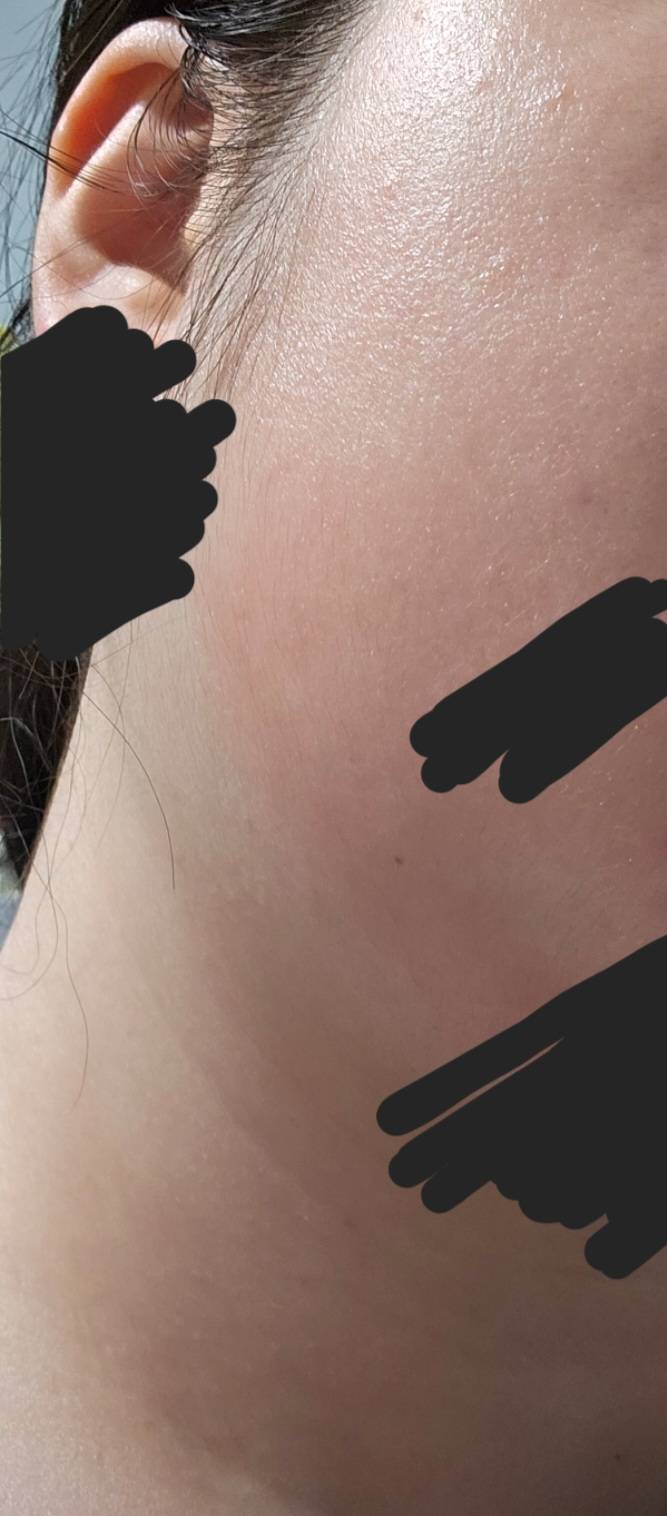 [잡담] 나 피부 왜이래....? 수분크림 바른 라인대로 이 꼴 났는데 화상인줄 | 인스티즈