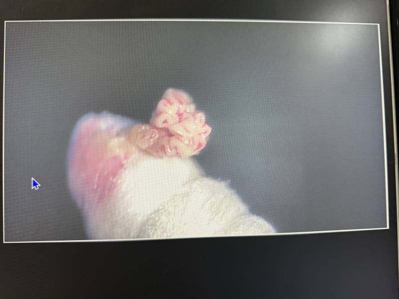 [잡담] 콩다래끼 뺀거 궁금한사람 ㅎㅇㅈㅇ | 인스티즈