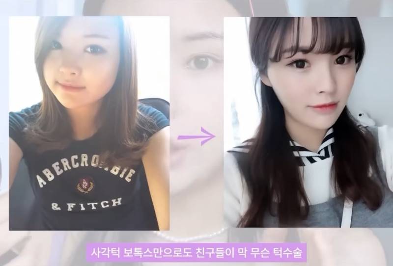 [잡담] 사각턱 보톡스 효과가 이정도야? | 인스티즈