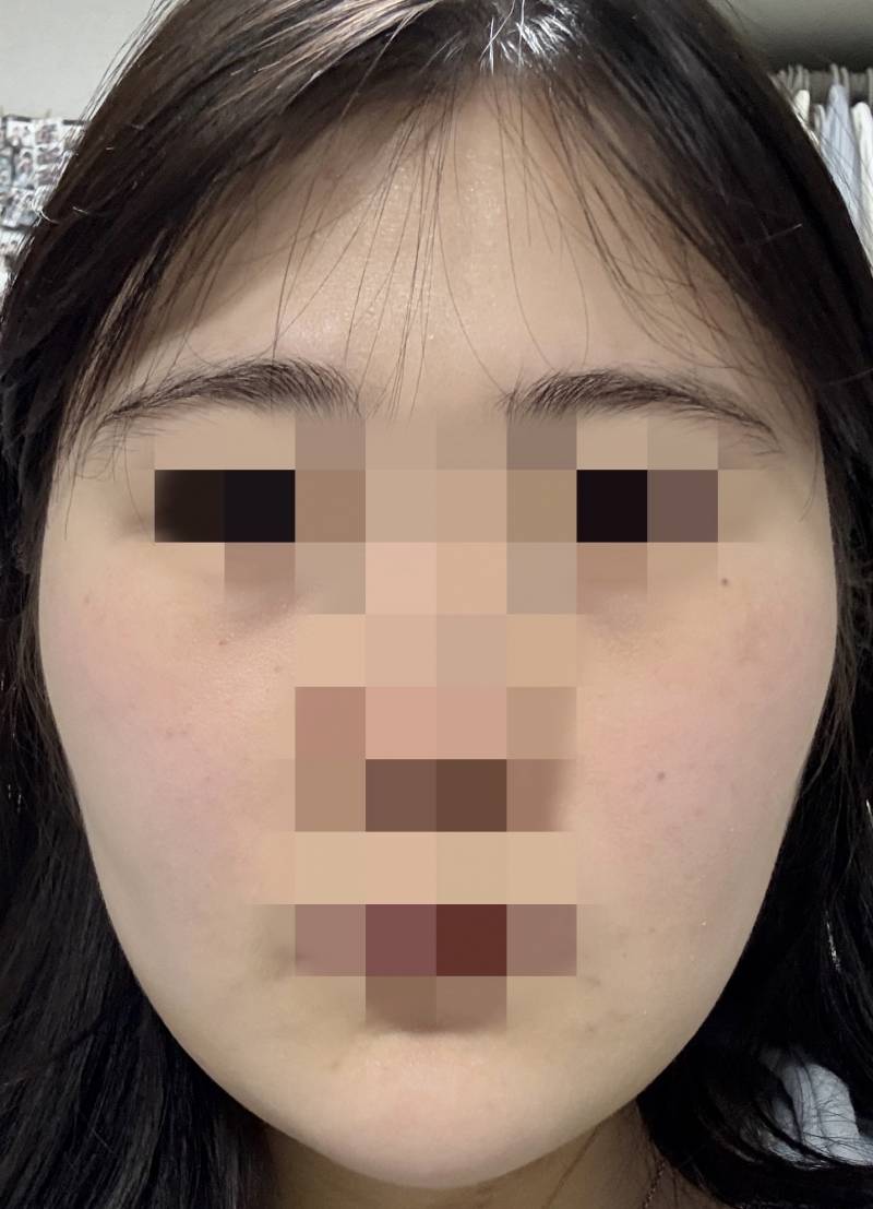 [잡담] 얼굴 지흡 했는데 아직 붓기 다 안빠진거겠지? | 인스티즈