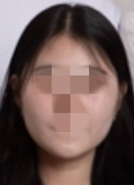 [잡담] 얼굴 지흡 했는데 아직 붓기 다 안빠진거겠지? | 인스티즈