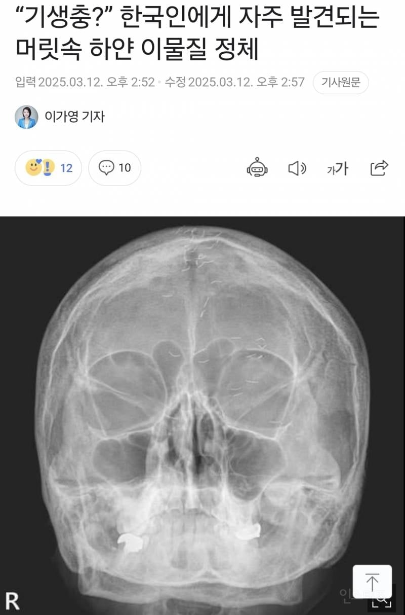 한국인에게서 발견되는 머리속 하얀 이물질 | 인스티즈