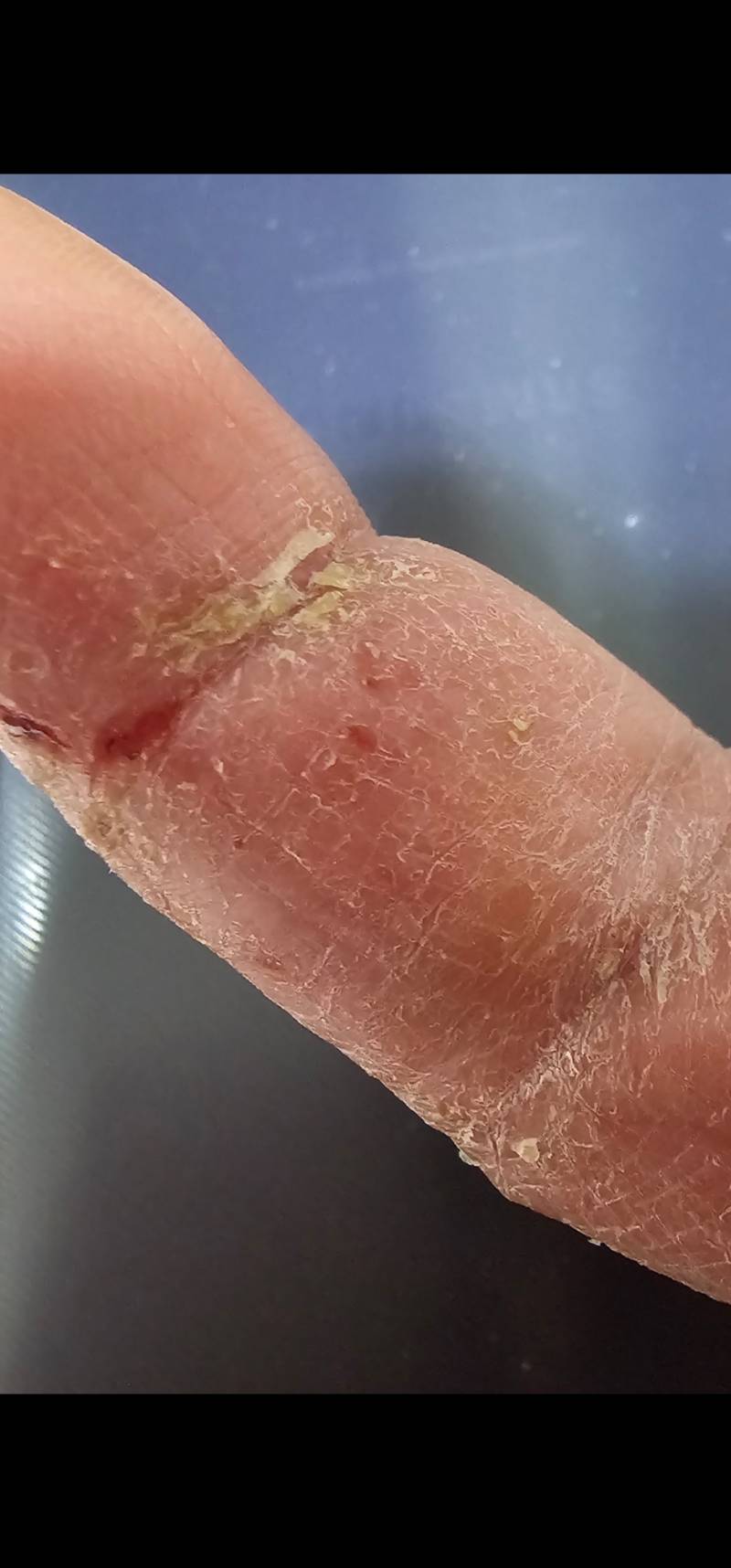 [잡담] 혐오주의 나 이거 한포진일까? 피부기포올라오고 나중에 미친듯이 가려워 | 인스티즈