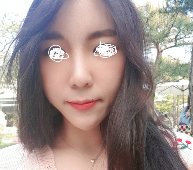 [잡담] 이번에 코 반영구 필러맞고 턱끝 필러맞았는데 부자연스러운지 봐줘 ㅠㅠ | 인스티즈