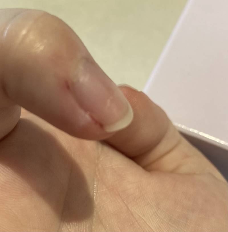 [잡담] 이거 곪은걸까? | 인스티즈