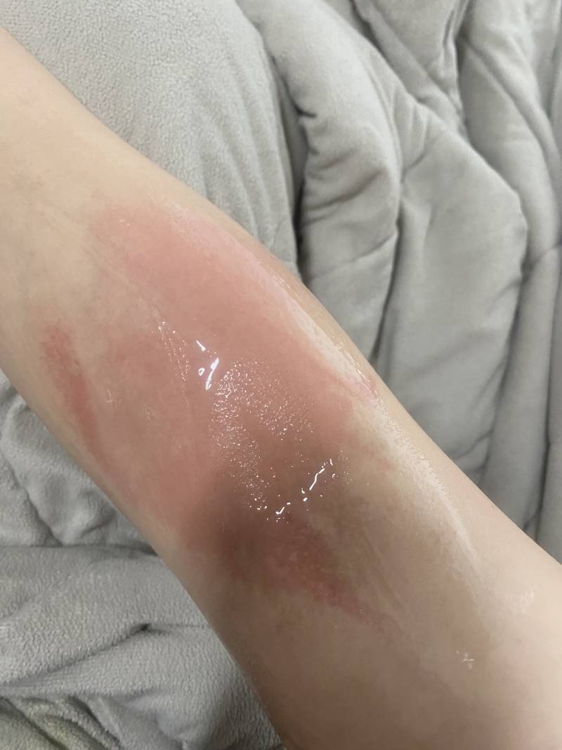 [잡담] 화상입었다,,,,하,,,,,,, | 인스티즈