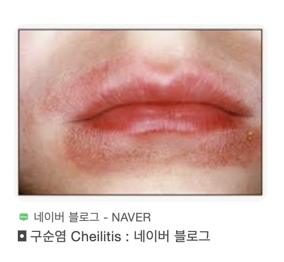 [잡담] 나 구순염이었구나 | 인스티즈