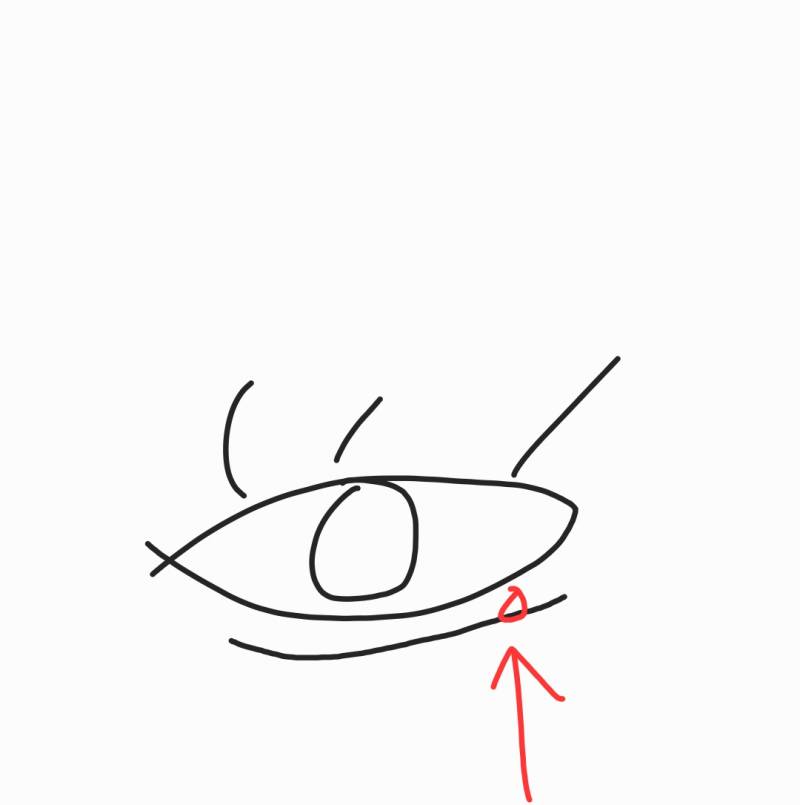 [잡담] 눈꺼풀은 아니고 눈 근처에 뭐 난 게 1년 넘게 안 없어지는데 이건 안과일까 피부과일까 | 인스티즈