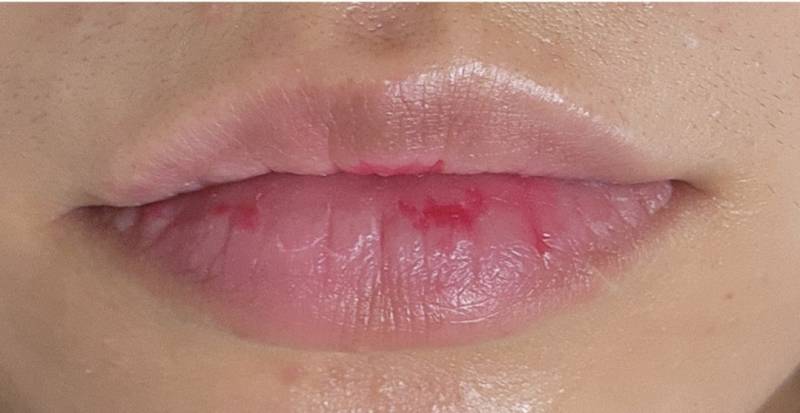 [잡담] 나 입술 필러 맞을지 안 맞을지 봐주라!! | 인스티즈