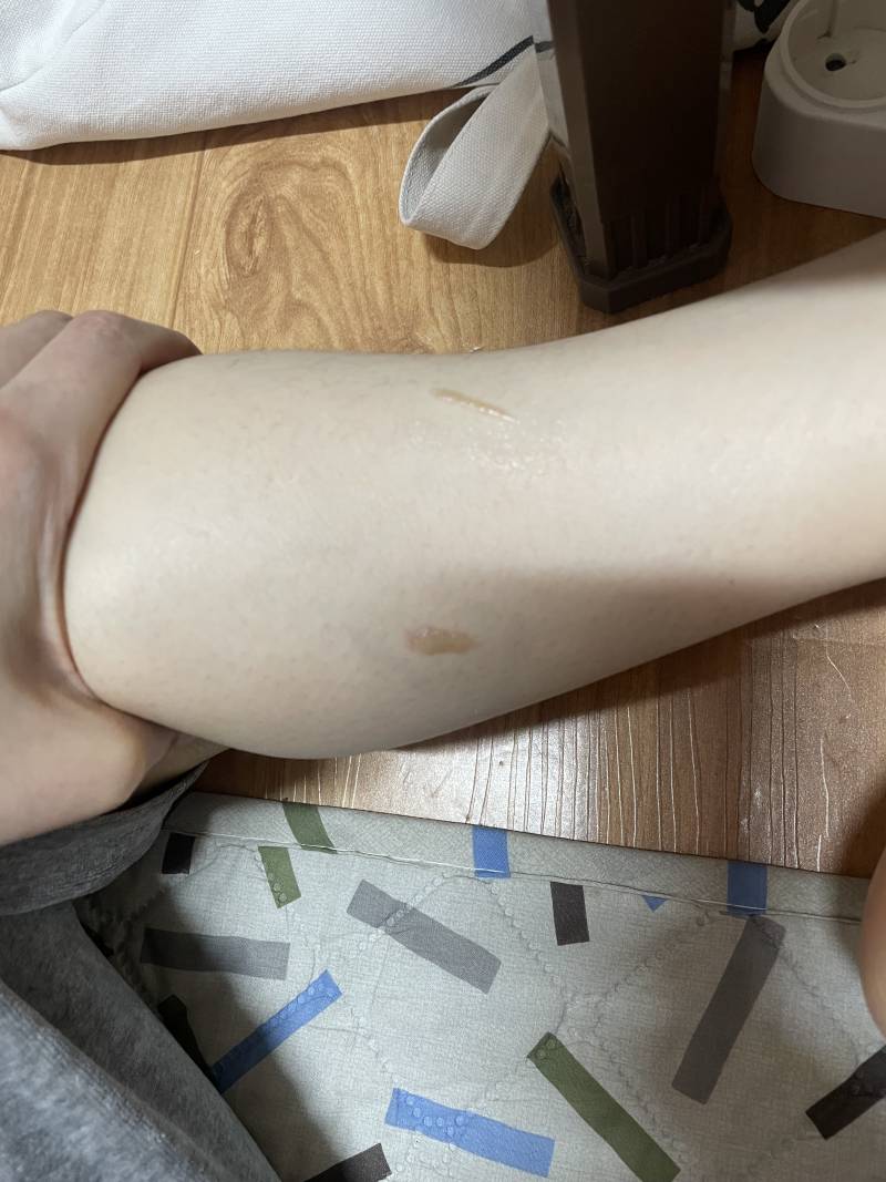 [잡담] 고데기 화상 이 정돈데 피부과 가도 될까? | 인스티즈