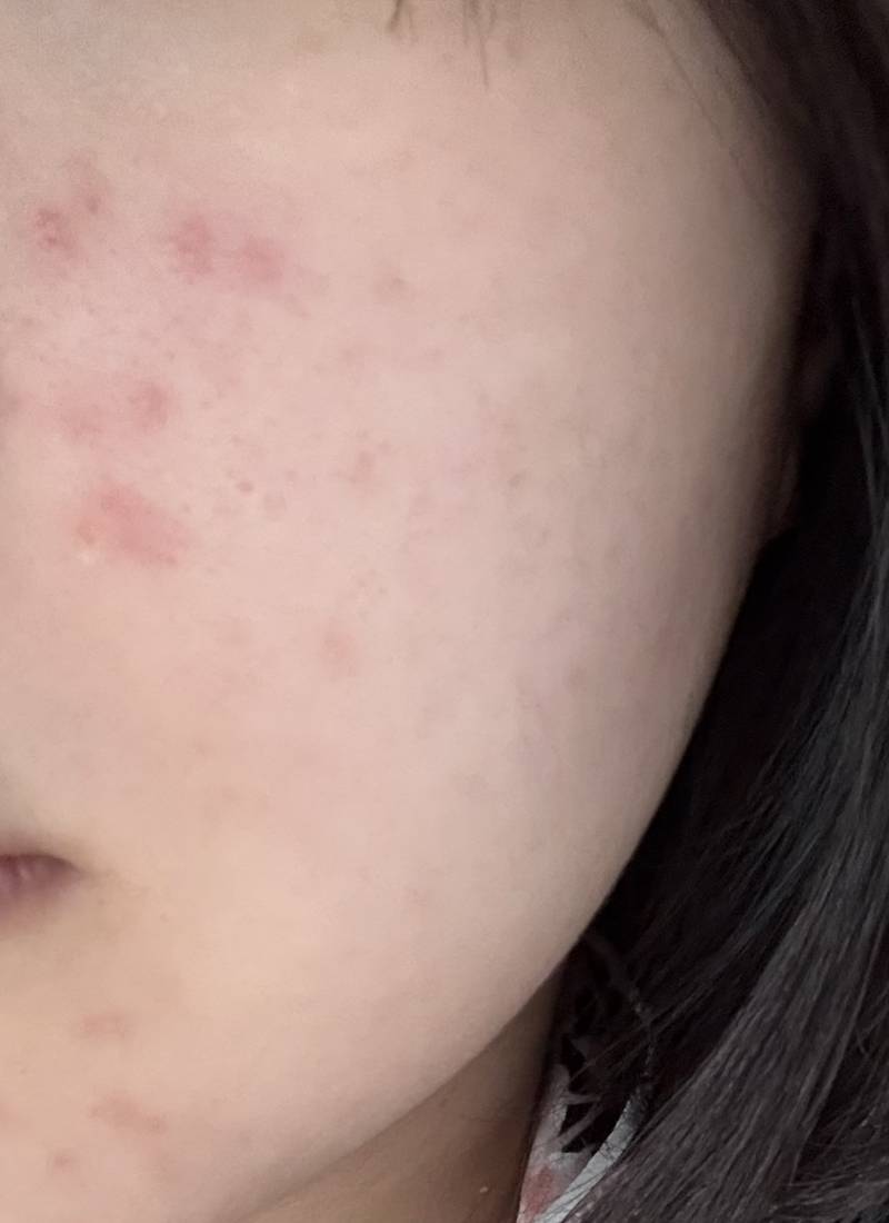 [잡담] 익들아 내 피부 왜이럴까 ㅠㅠ 뒤집어짐 ㅎㅇㅈㅇ | 인스티즈