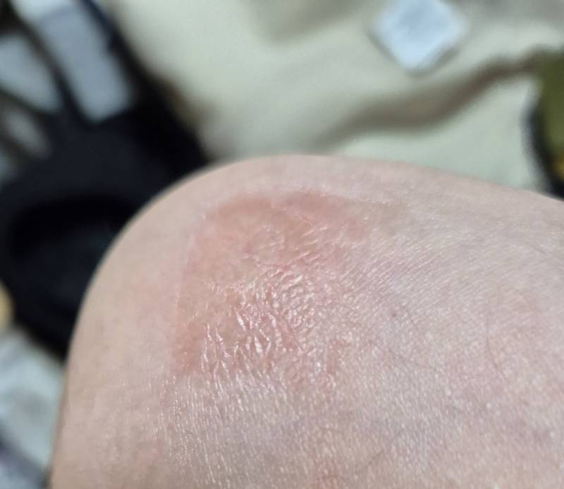 [잡담] 밴드 자국..?이거 어떡하지 한 번 봐줄 익ㅠㅜㅠ | 인스티즈