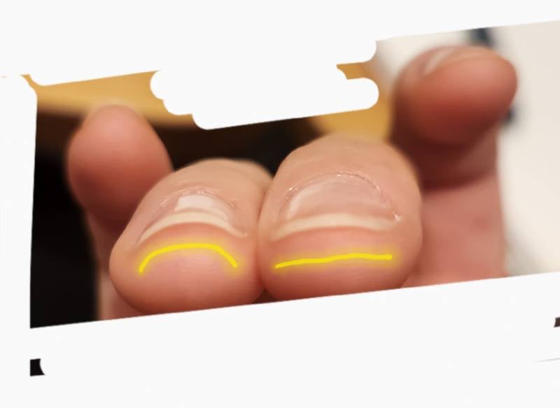 [잡담] 손톱이 납작해지는데 왜이래? | 인스티즈