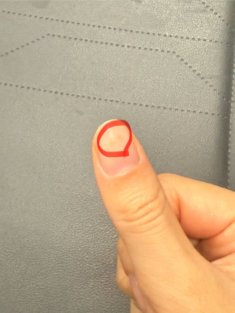 [잡담] 이거 손톱 곰팡이인가? | 인스티즈