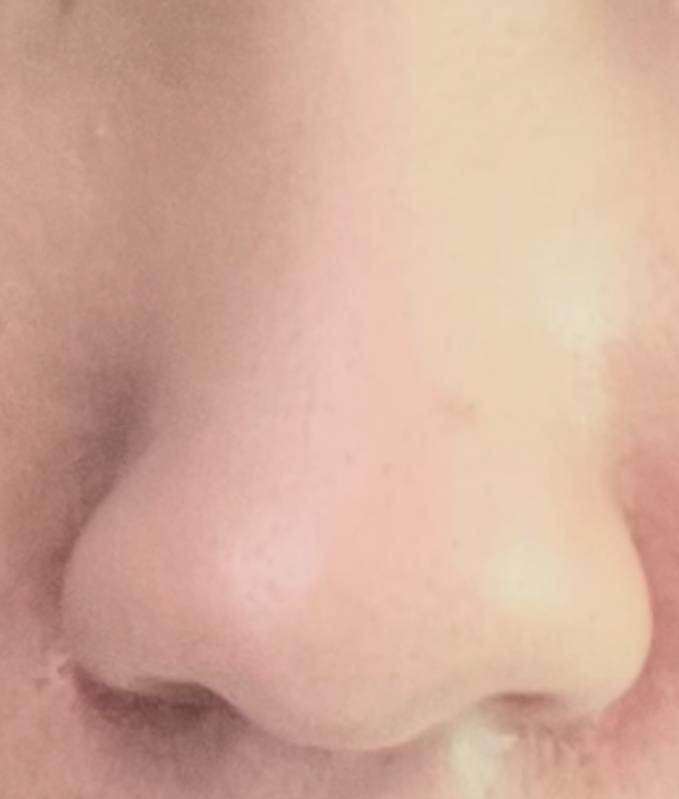 [잡담] 콧망울쪽이 넘 부해보이는데 방법 없을까.. | 인스티즈